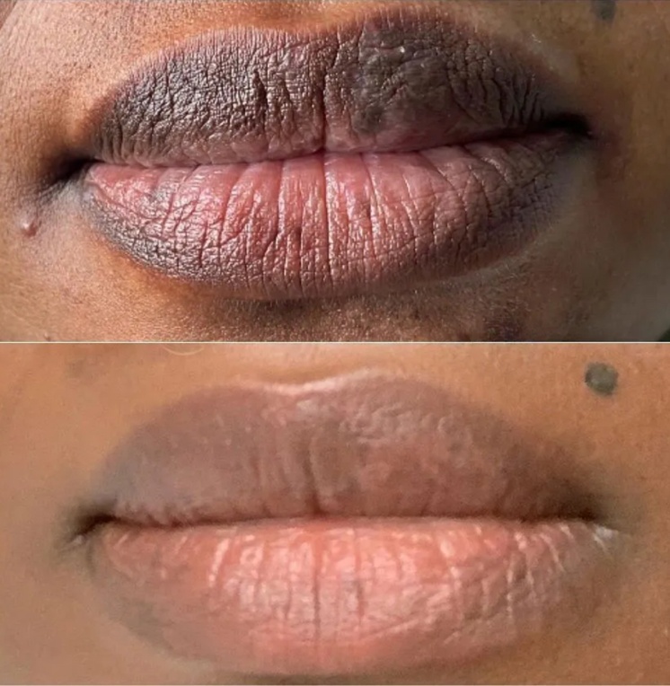 Services lip neutralization